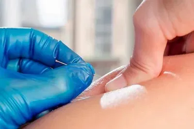 Unlocking Pain Relief: The Power of IMS/Dry Needling