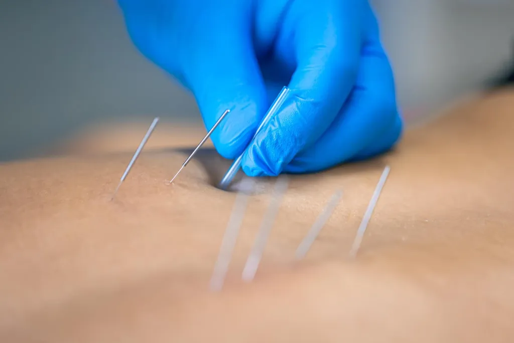 IMS dry-needling applied to a patient’s muscle by a clinician
