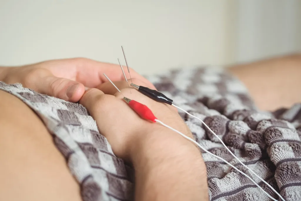 Clinician inserting a dry-needle into a patient's lower back muscle group